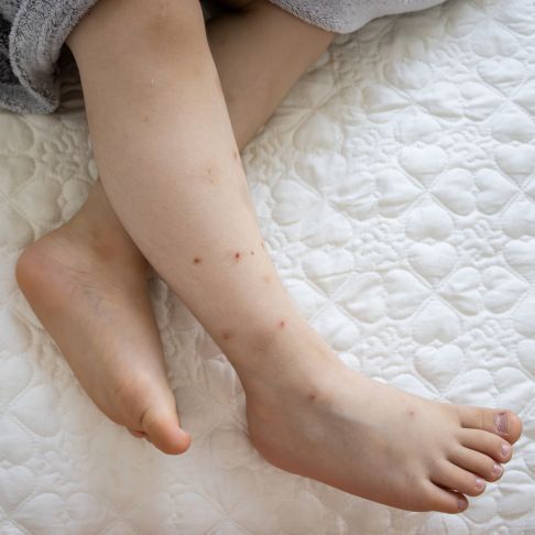Boutons de moustique sur une jambe 